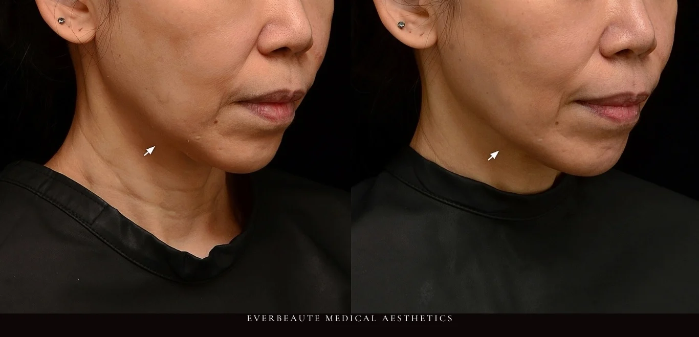 逆時針Profhilo原廠指定凝境美學診所曾繁聞院長示範注射案例，皮膚科醫學會年會演講：改善眼下細紋、臉頰乾紋與口角皺紋，膚質緊緻透亮自然，深層保濕效果顯著。