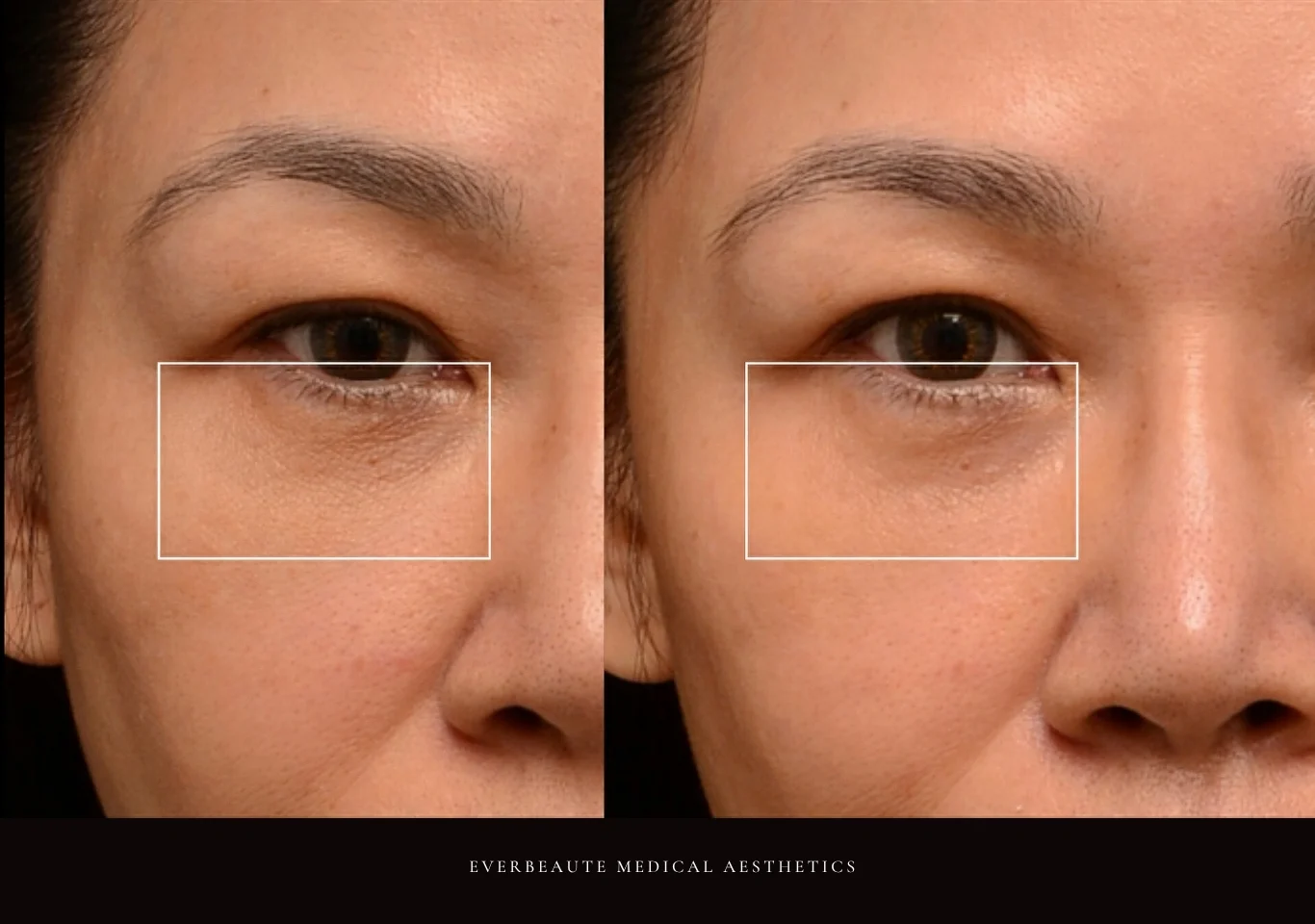 逆時針Profhilo原廠指定凝境美學診所曾繁聞院長示範注射案例，皮膚科醫學會年會演講：改善眼下細紋、臉頰乾紋與口角皺紋，膚質緊緻透亮自然，深層保濕效果顯著。