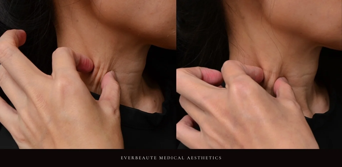 逆時針Profhilo原廠指定凝境美學診所曾繁聞院長示範注射案例，皮膚科醫學會年會演講：改善眼下細紋、臉頰乾紋與口角皺紋，膚質緊緻透亮自然，深層保濕效果顯著。