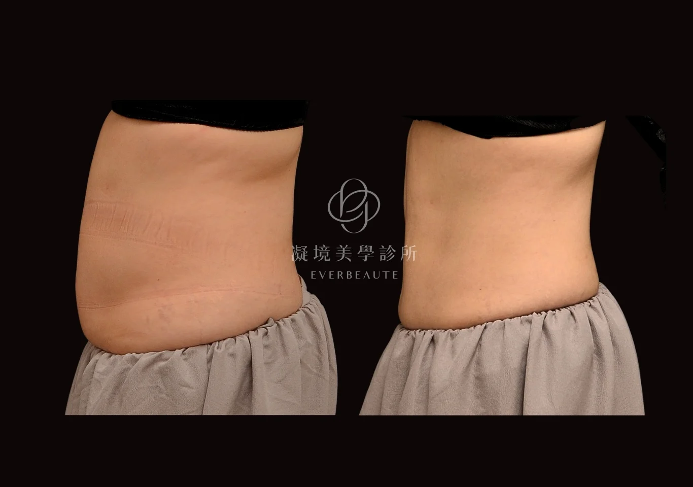 酷塑elite 美國冷凍減脂 小腹 腹部肥胖 瘦腰 瘦肚子