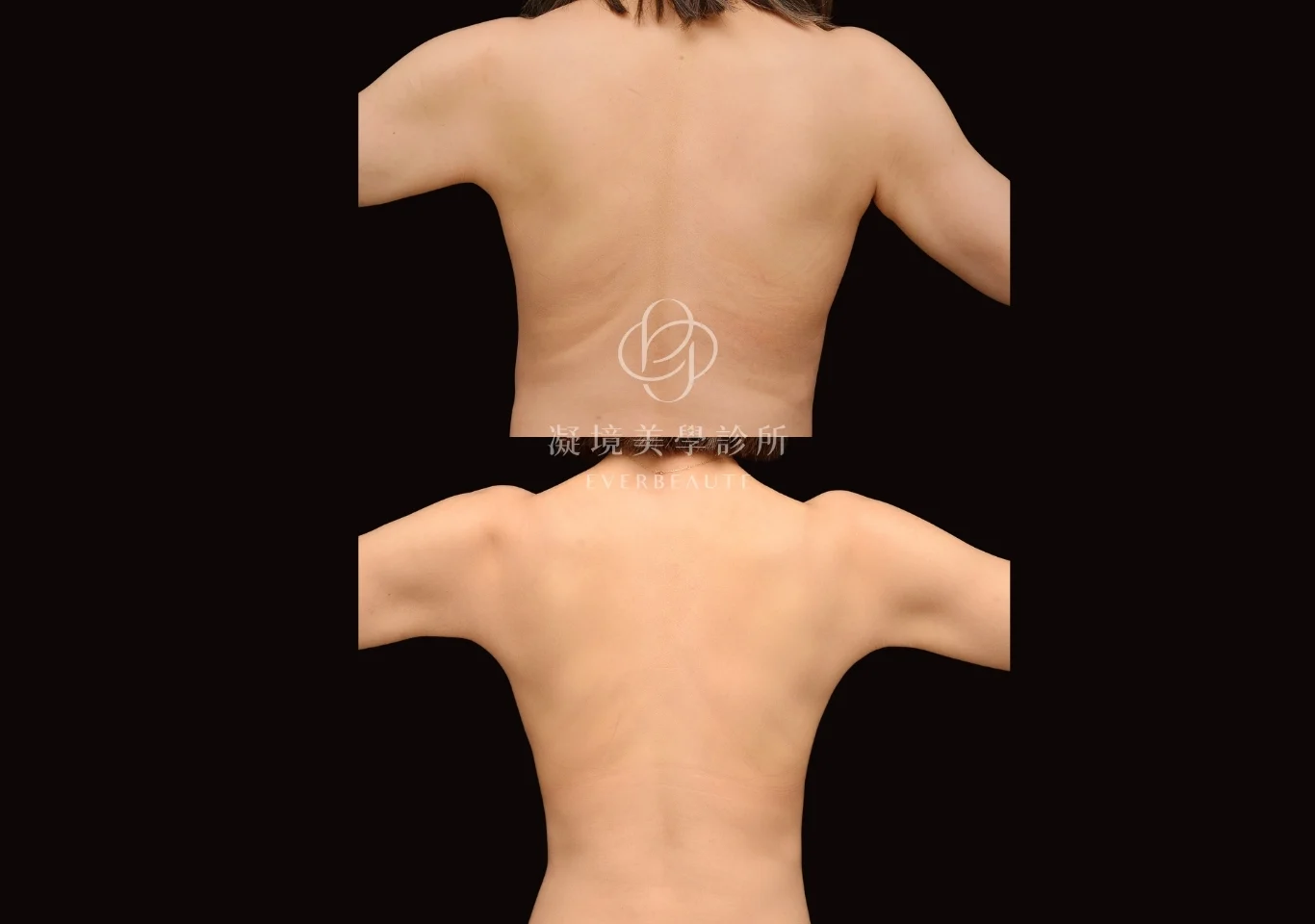 酷塑elite 美國冷凍減脂 瘦手臂 掰掰袖 蝴蝶袖 凝境美學診所 案例 曾繁聞醫師 于曉恩醫師