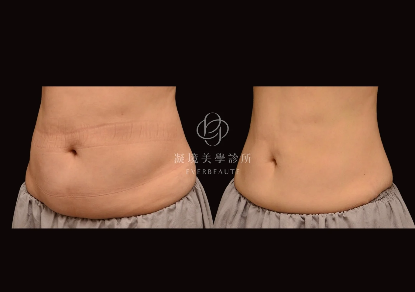 酷塑elite 美國冷凍減脂 瘦手臂 掰掰袖 蝴蝶袖 凝境美學診所 案例 曾繁聞醫師 于曉恩醫師