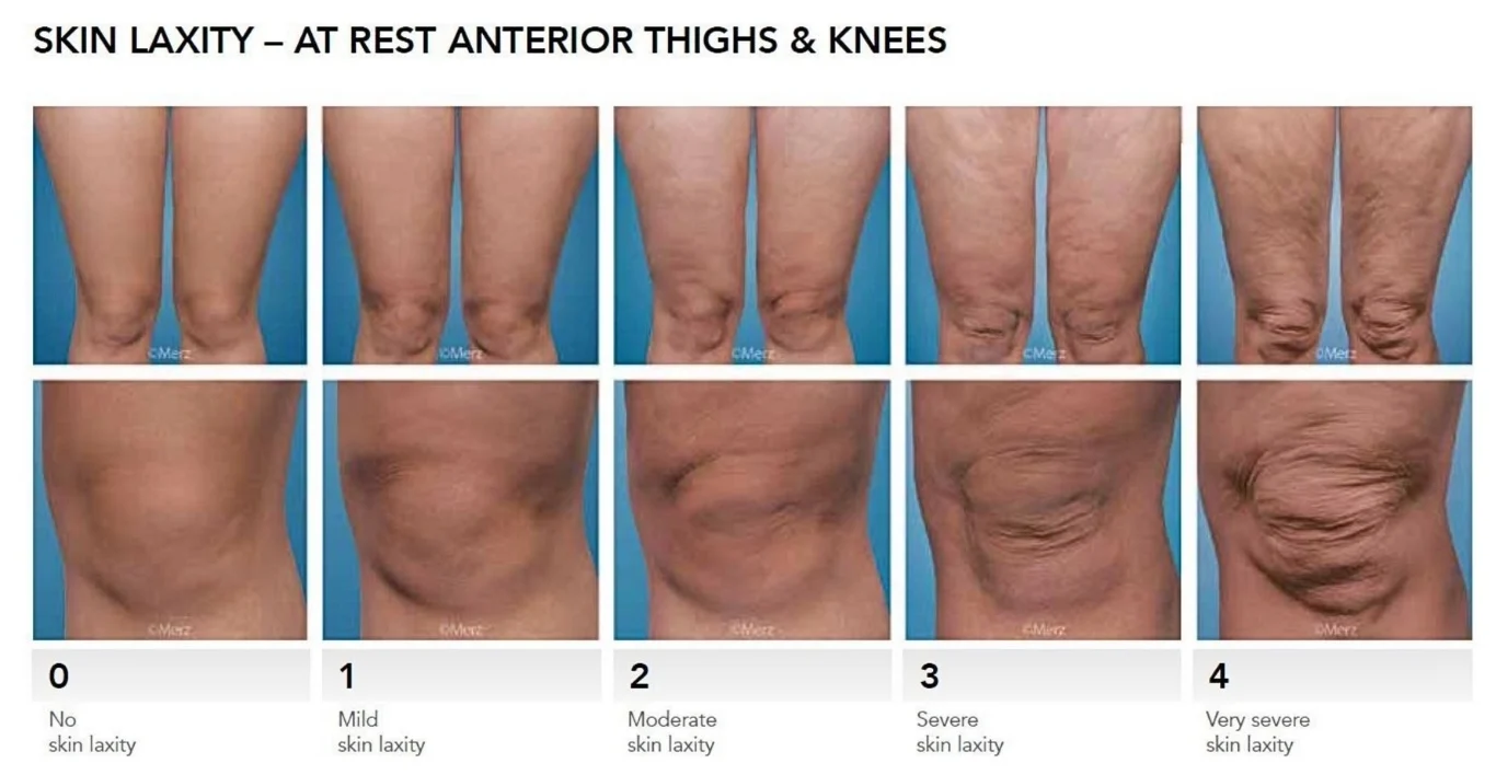 膝蓋鬆弛與皺褶的嚴重度分級，0級代表光滑緊緻的膝蓋皮膚，4級代表最嚴重的膝蓋皮膚鬆弛、皺紋、皺摺