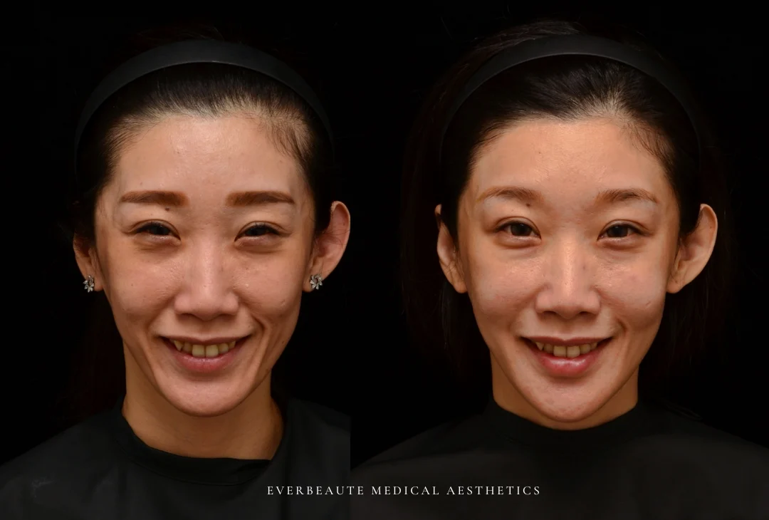 微整型國際級教官曾繁聞院長 為來台受訓的香港整形美容醫師演示進階注射技術。使用緹奧希Teoxane RHA隱形玻尿酸全臉填充後，達到動態自然不僵硬的效果，改善口周皺紋括弧紋