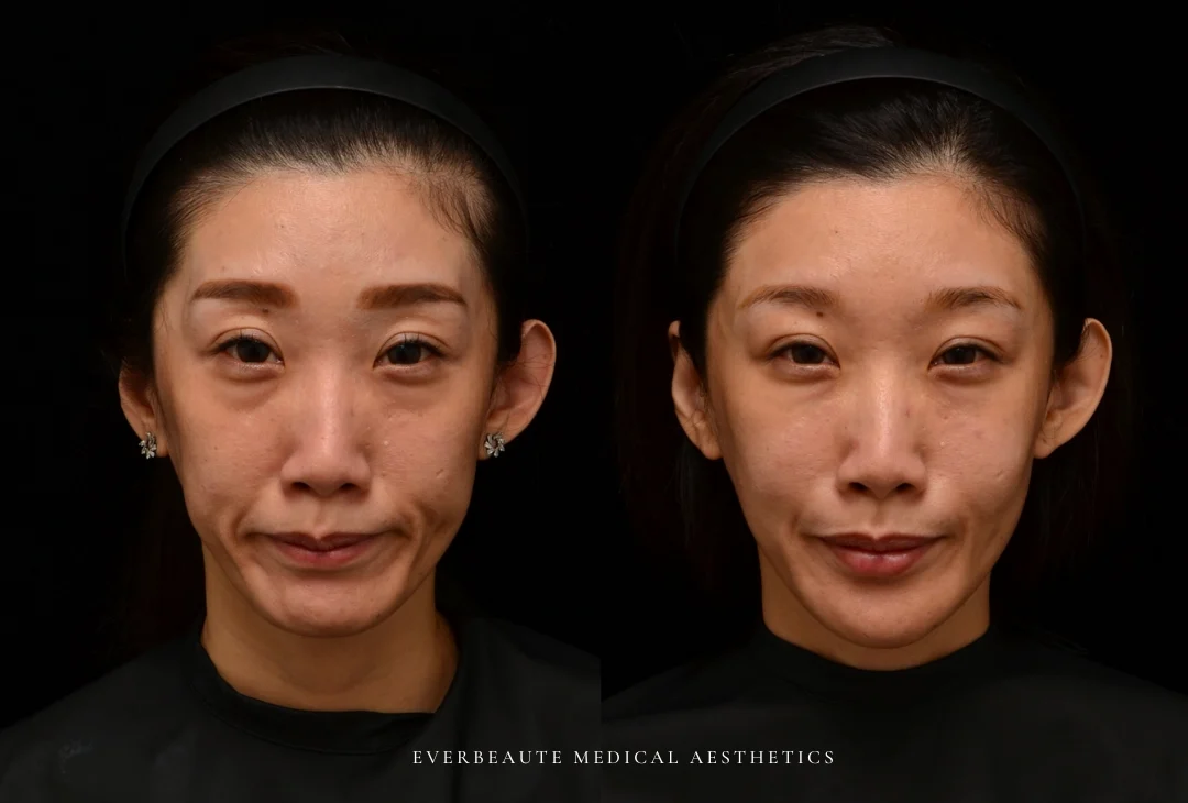 微整型國際級教官曾繁聞院長 為來台受訓的香港整形美容醫師演示進階注射技術。使用緹奧希Teoxane RHA隱形玻尿酸全臉填充後，達到動態自然不僵硬的效果