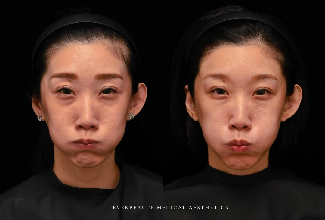 微整型國際級教官曾繁聞院長 為來台受訓的香港整形美容醫師演示進階注射技術。使用緹奧希Teoxane RHA隱形玻尿酸全臉填充後，達到動態自然不僵硬的效果