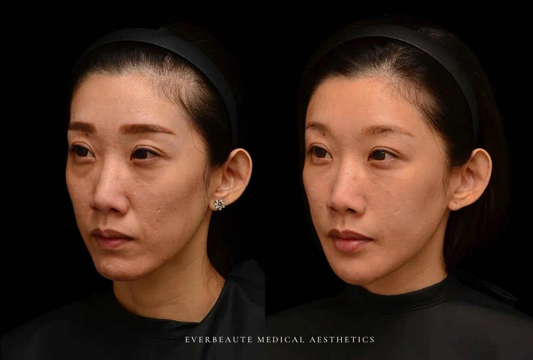 微整型國際級教官曾繁聞院長 為來台受訓的香港整形美容醫師演示進階注射技術。玻尿酸改善淚溝、眼袋、黑眼圈、法令紋、木偶紋、豐唇、下巴塑型、填充臉頰凹陷、嘴邊肉拉提、外輪廓拉提