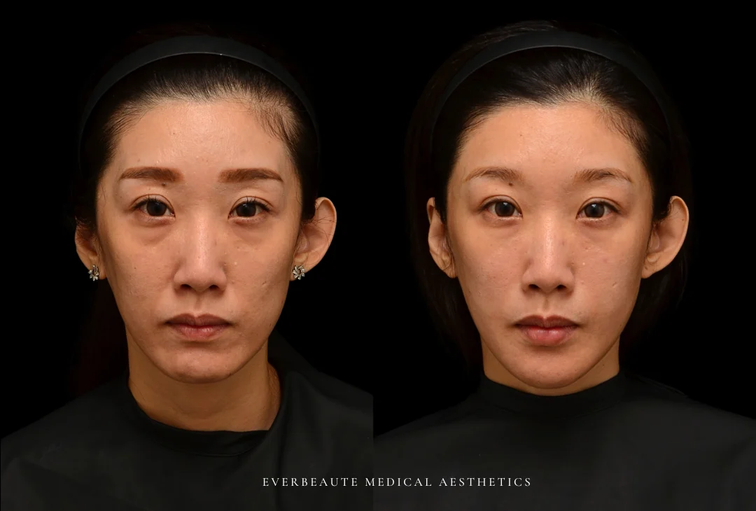 微整型國際級教官曾繁聞院長 為來台受訓的香港整形美容醫師演示進階注射技術。玻尿酸改善淚溝、眼袋、黑眼圈、法令紋、木偶紋、豐唇、下巴塑型、填充太陽穴/夫妻宮、臉頰凹陷、外輪廓平整