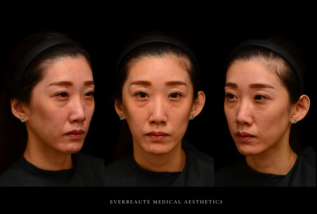 凝境美學院長 為香港整形美容醫師進階微整型教學案例 1