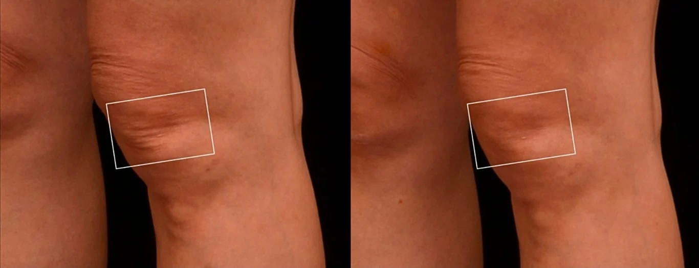 改善膝蓋皺紋：凝境美學診所真實案例