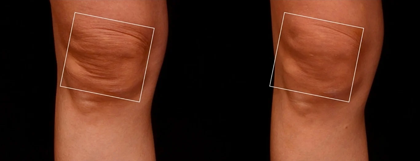 複合式治療改善膝蓋皺褶：凝境美學診所真實案例