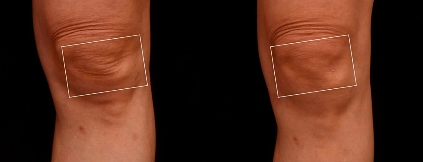 複合式治療改善膝蓋皺褶：凝境美學診所真實案例1