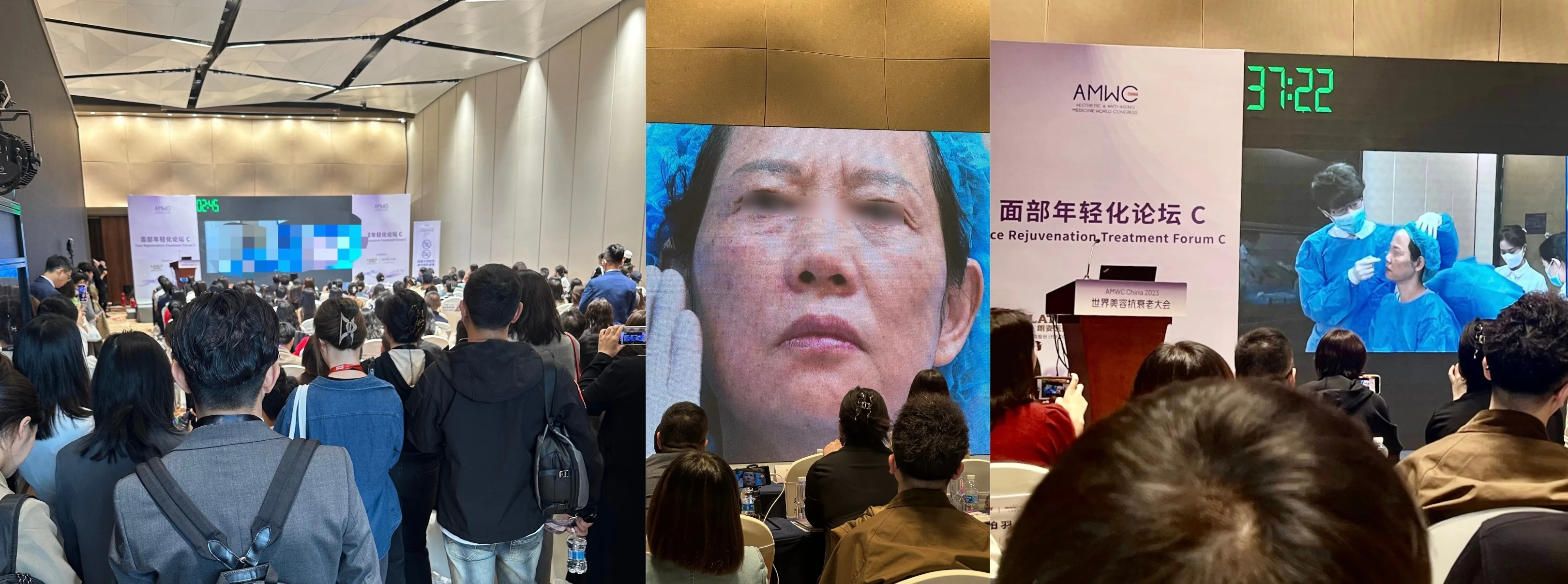  AMWC China凝境美學曾繁聞醫師中國大陸現場示範無痕注射拉提即刻效果