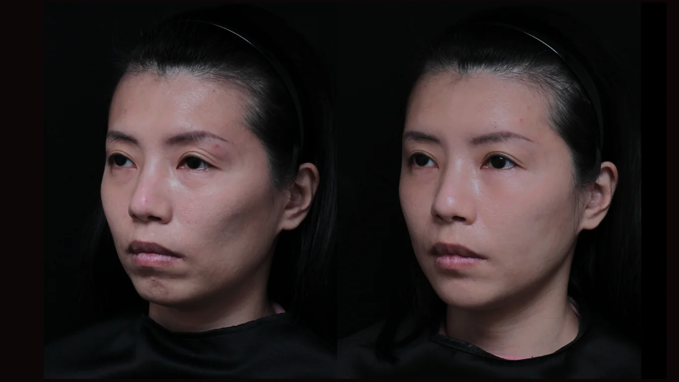 保柔緹水無痕玻尿酸效果 凝境美學曾繁聞醫師案例