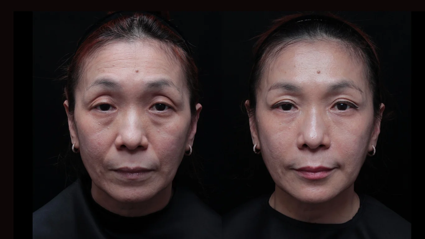 Restylane瑞絲朗玻尿酸效果 凝境美學曾繁聞醫師案例
