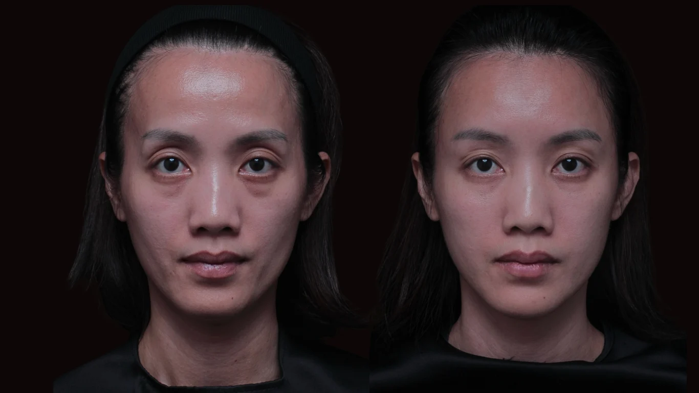 Restylane OBT瑞絲朗女神動態玻尿酸效果 凝境美學曾繁聞醫師案例