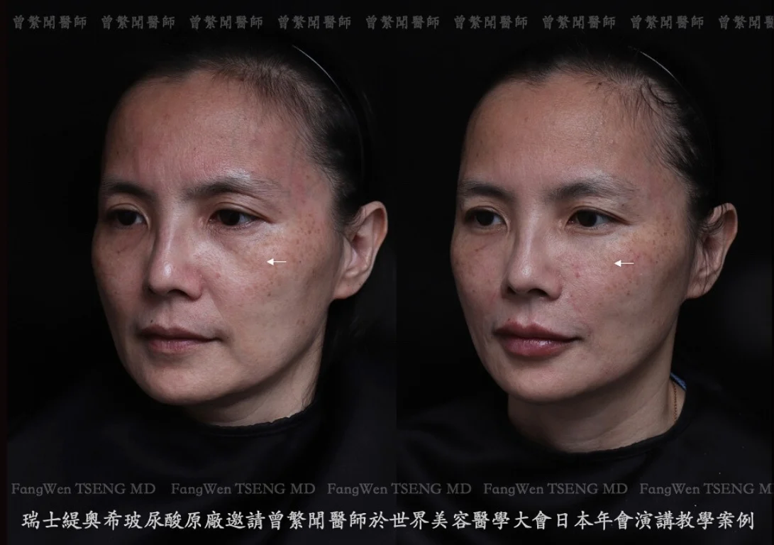 玻尿酸淚溝法令紋豐唇即刻效果