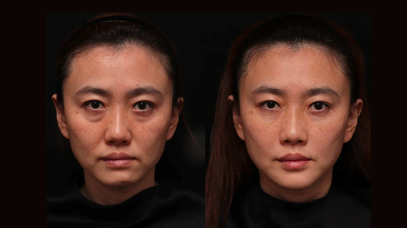 凝境美學診所玻尿酸注射案例 淚溝 眼袋 木偶紋 無痕拉提