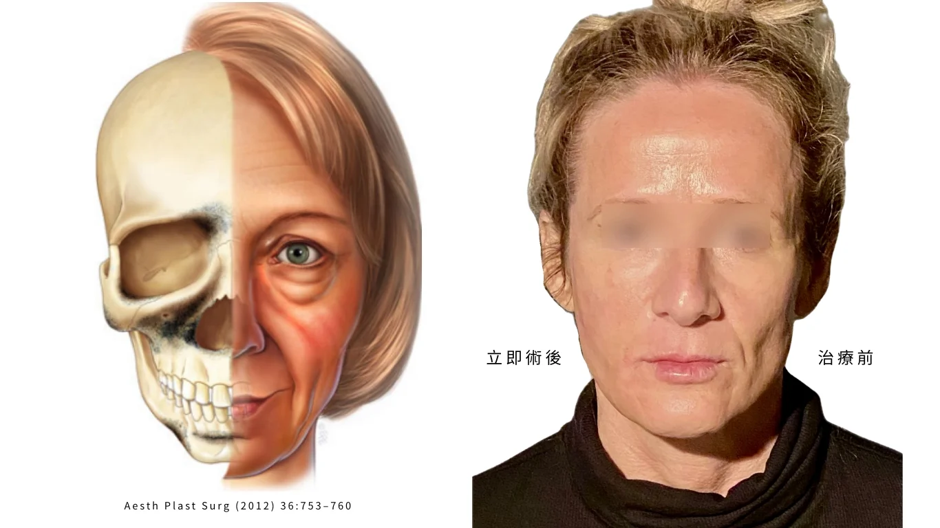 臉部老化下垂原因 凝境美學曾繁聞醫師無痕筋膜拉提玻尿酸注射案例