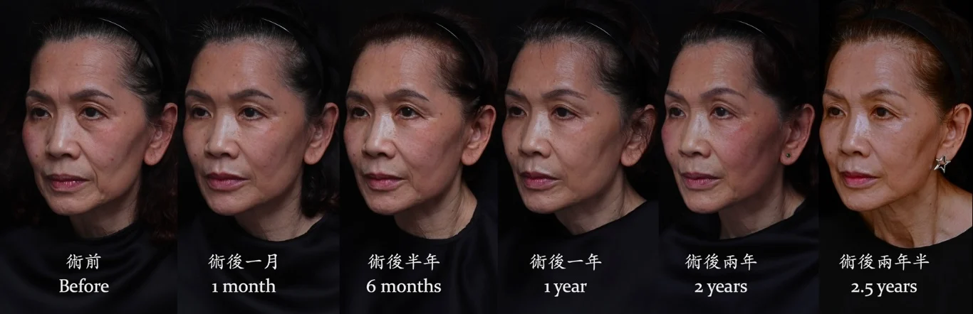 玻尿酸 淚溝 眼袋 木偶紋 下顎線 皺眉紋 無痕拉提兩年半長效自然