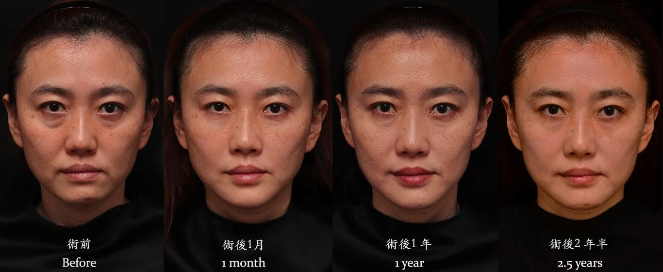 玻尿酸淚溝眼袋木偶紋無痕拉提效果兩年半長效