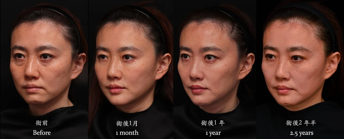 玻尿酸淚溝眼袋木偶紋無痕拉提效果兩年半長效