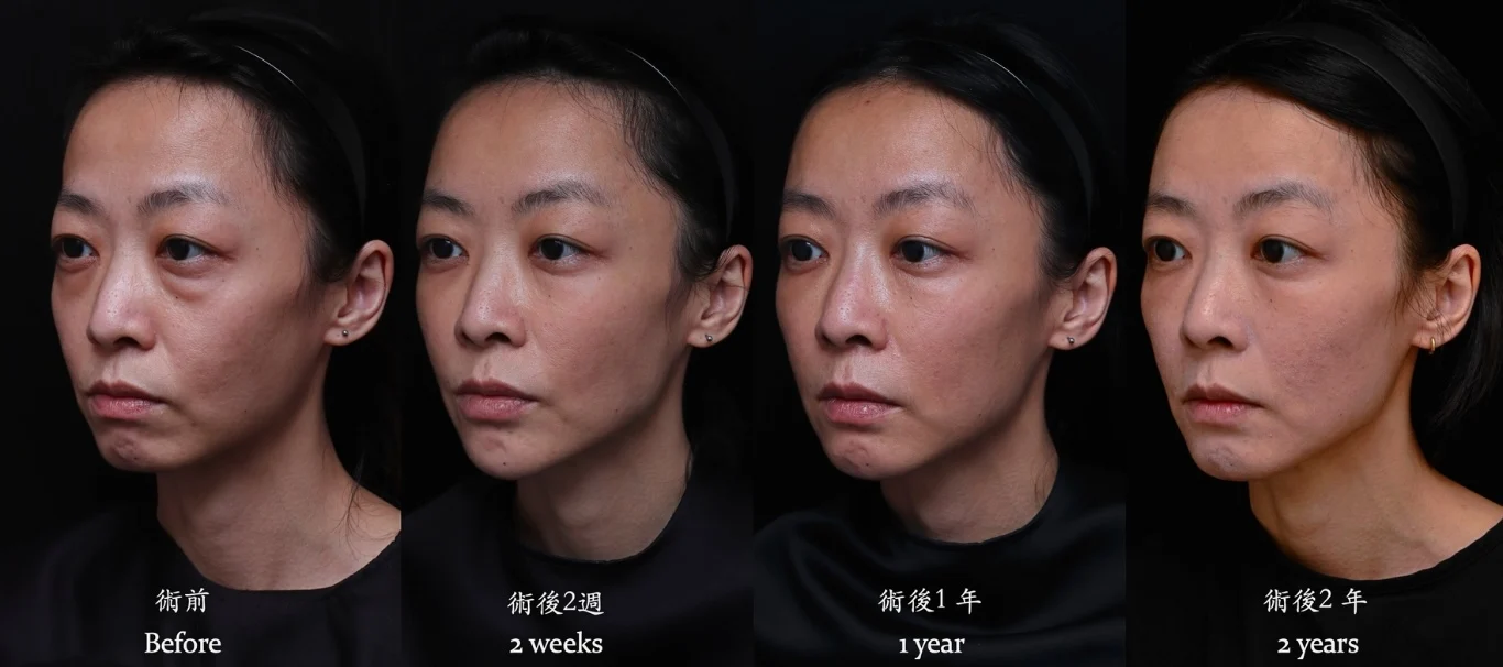 玻尿酸淚溝眼袋無痕拉提效果兩年長效