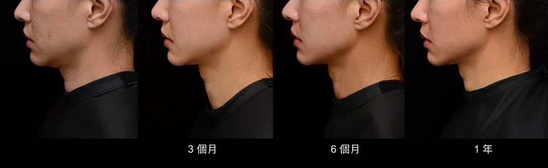 美國音波二代極透+治療改善雙下巴與下顎線案例，術前與術後1年對比，長效維持度Ultherapy Prime