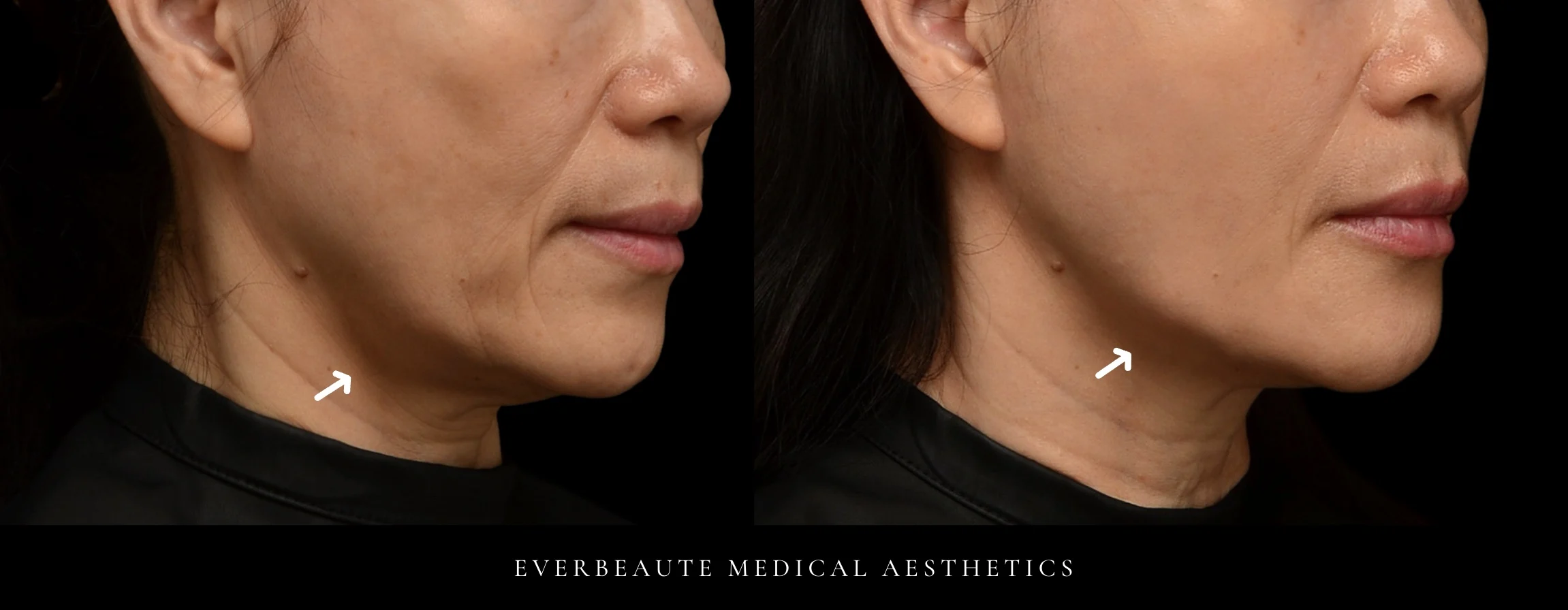 于曉恩醫師 改善嘴邊肉 台北醫美