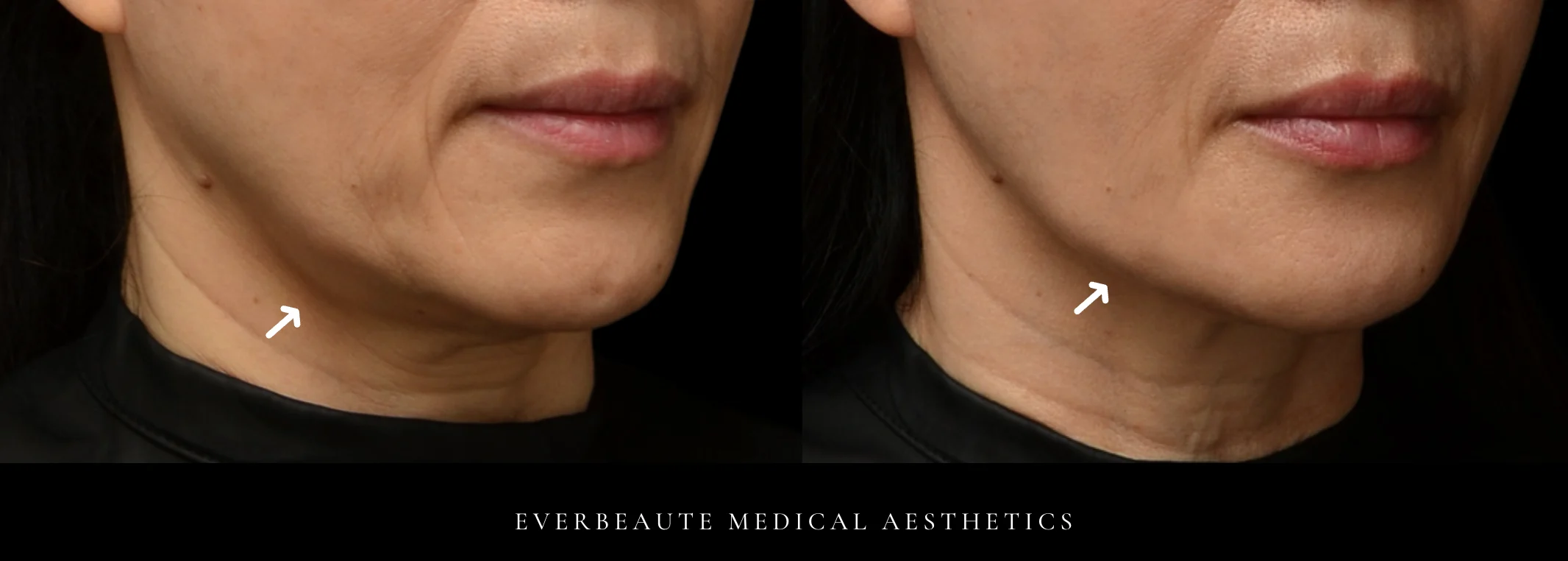 下半臉輪廓變化初步觀察示意