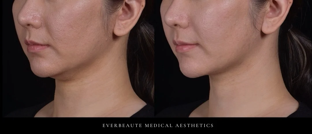 雙下巴改善 台北醫美 凝境美學 于曉恩醫師