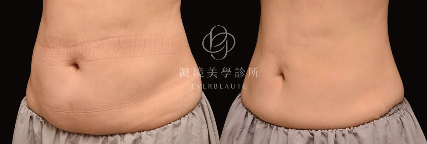 女生CoolSculpting Elite 腹部冷凍減脂治療前後正面對比