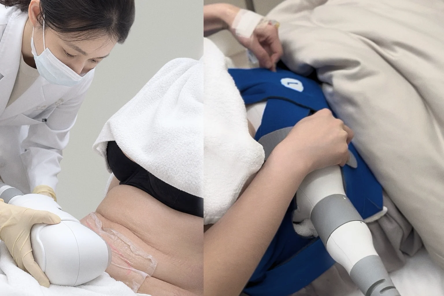 CoolSculpting Elite 腹部冷凍減脂