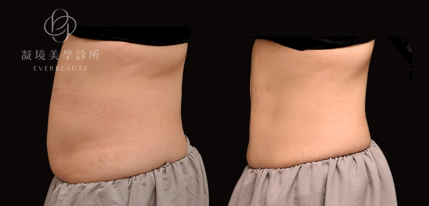 CoolSculpting Elite 腹部冷凍減脂治療前後正面對比