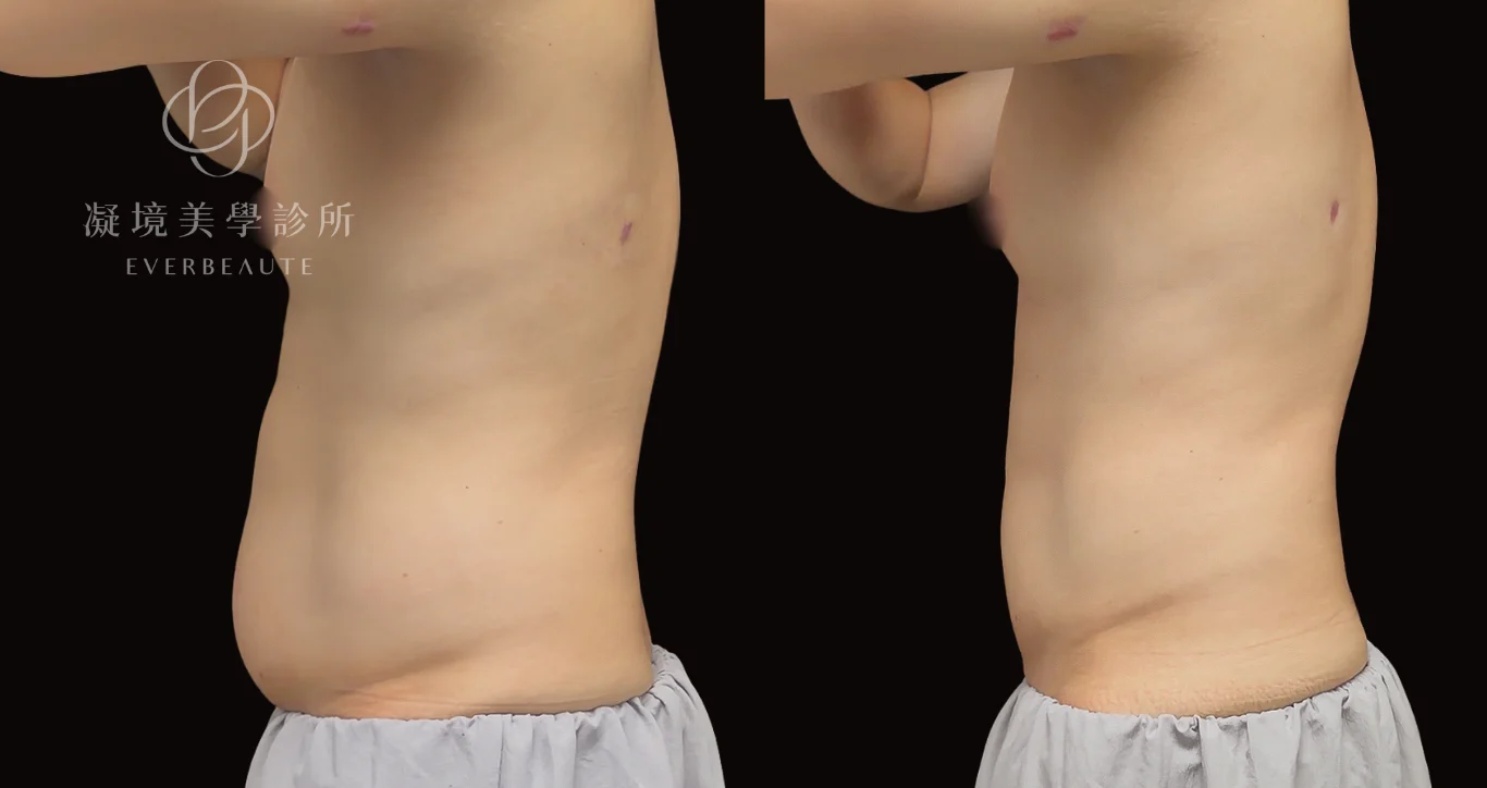 男性 CoolSculpting Elite 腹部冷凍減脂治療前後正面對比
